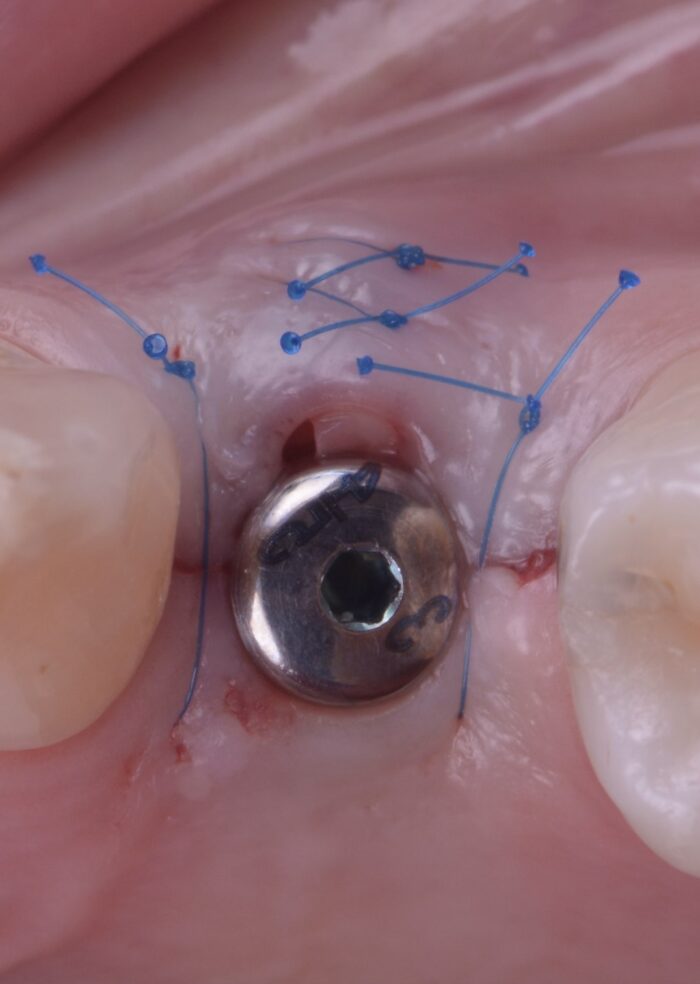 Tissus mous et implants 5 et 6 février 2026 – Image 6