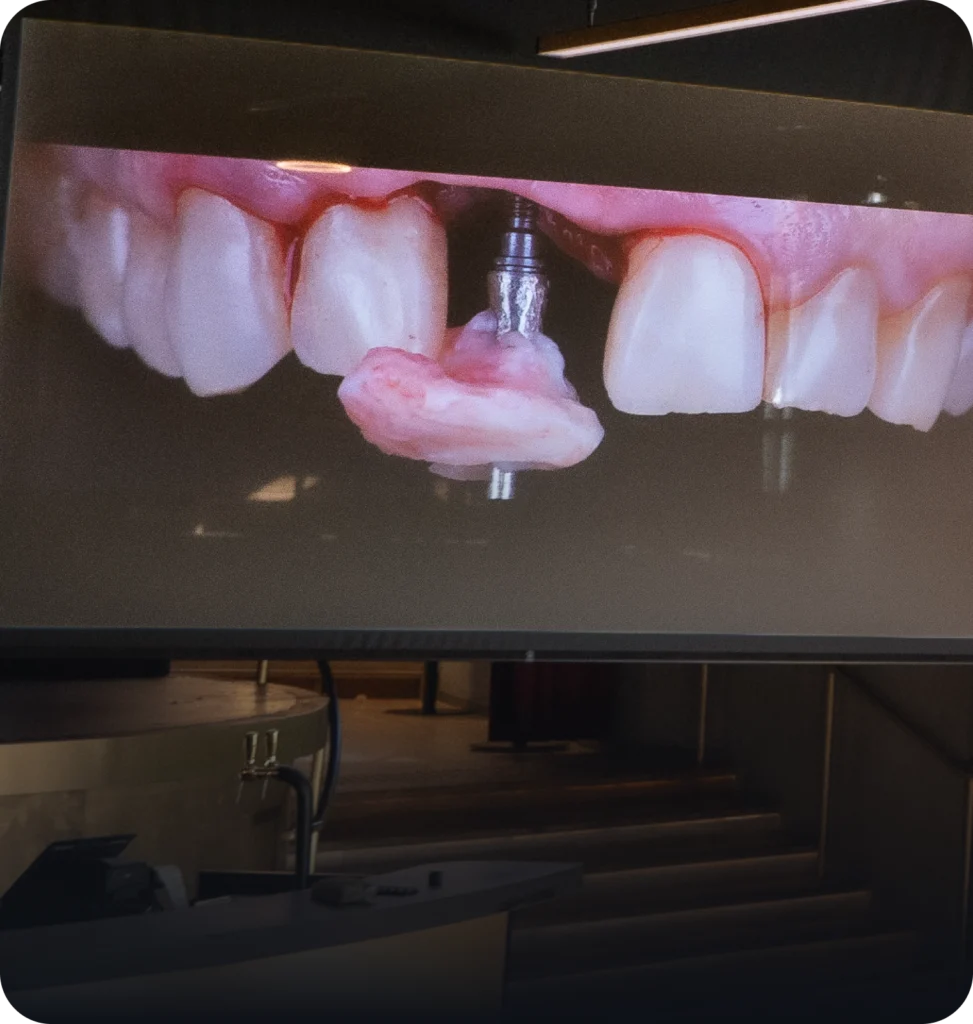 Gestion des tissus mous autour des implants
