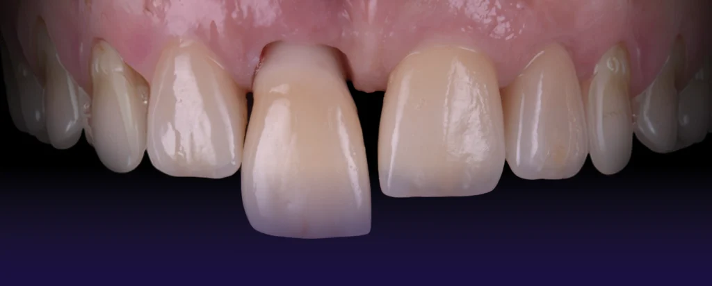Module 3 : Masterclass Implants