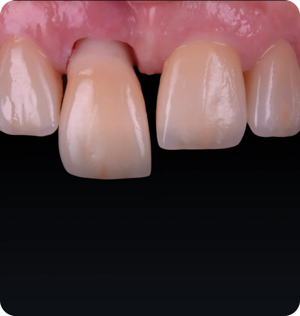 Module 3 : Masterclass Implants